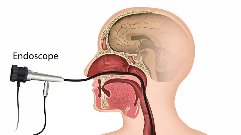 TransnasalEsophagoscopy